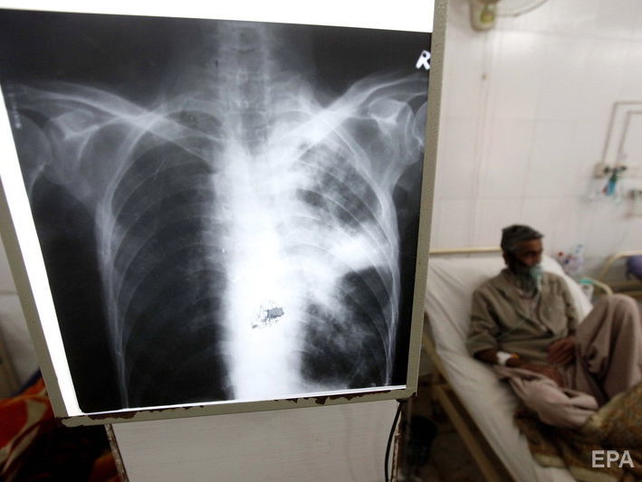 ﻿Туберкульоз залишається найсмертоноснішою хворобою у світі – Всесвітня організація охорони здоров'я